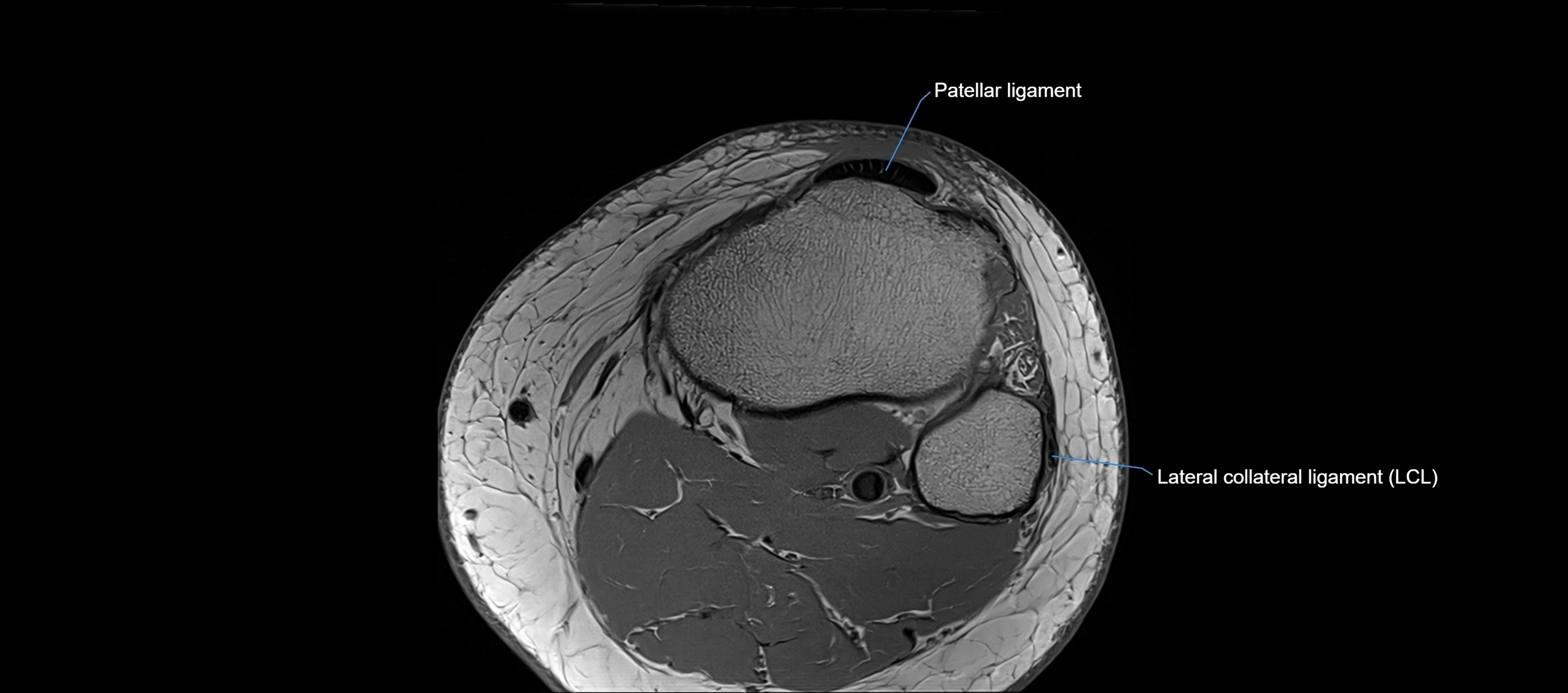MRI Knee axial  ligaments cross sectional anatomy 3T  radiology  image-img-03001-00042.webp